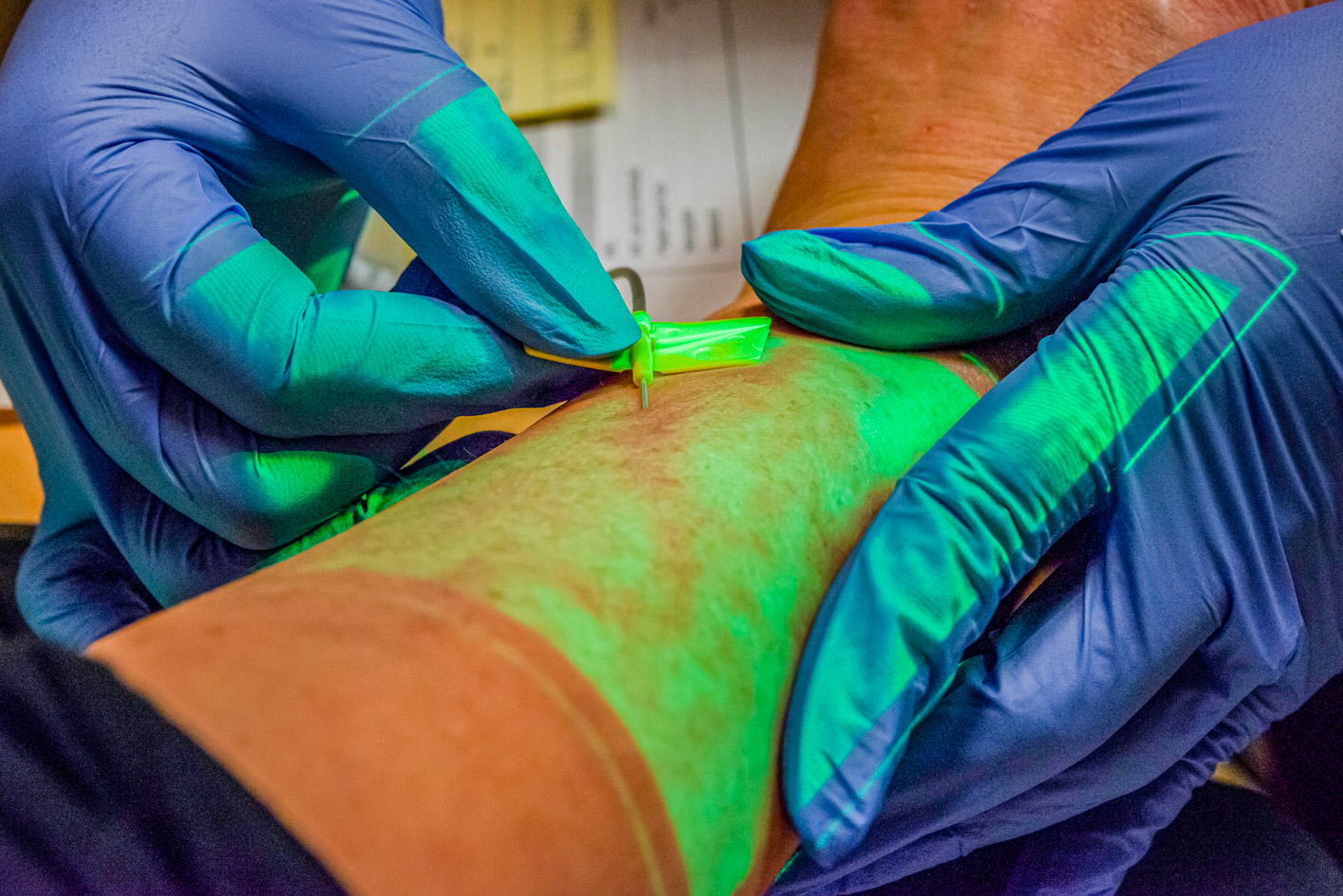 Gloved nurse using a vein finder and butterfly setup to insert a hypodermic needle into a superficial vein on a patient's arm for an IV infusion.